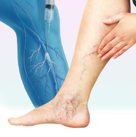 Sclerotherapy Treatment