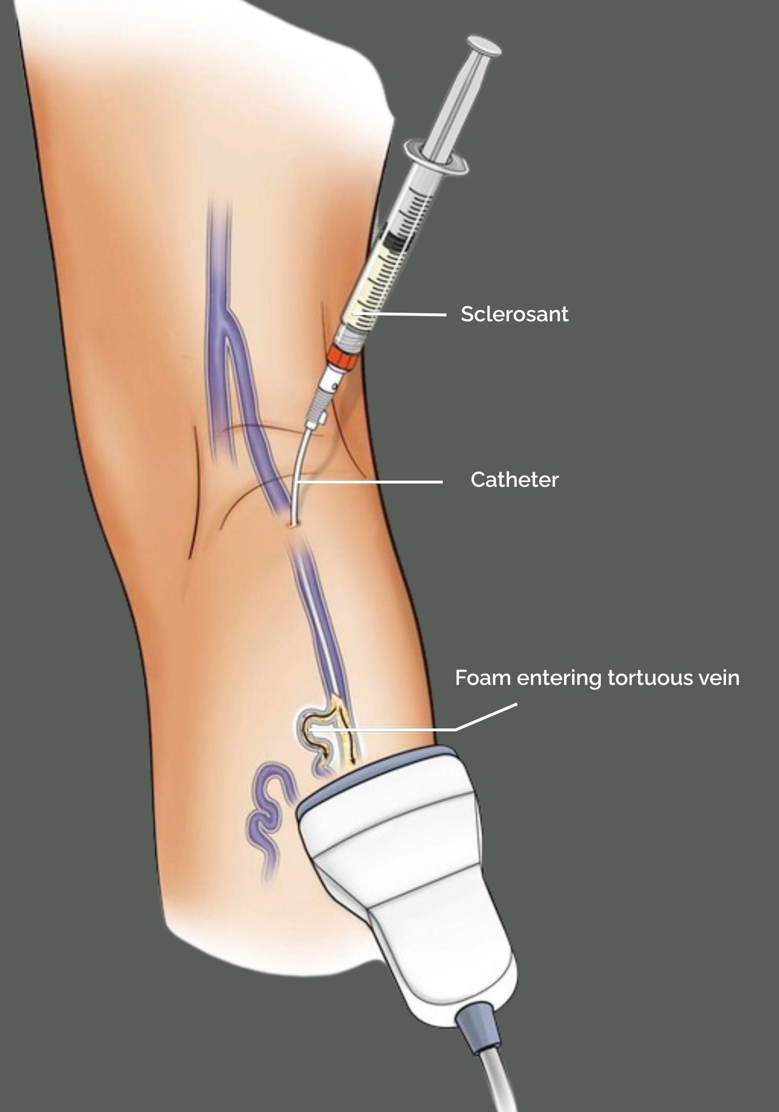 Tortuos Vein